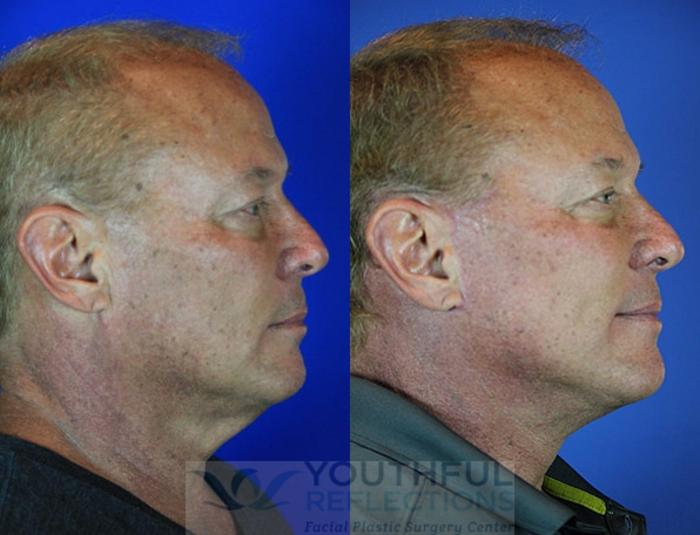 Facelift / Reflection Lift Case 69 Before & After Right Side | Nashville, TN | Youthful Reflections