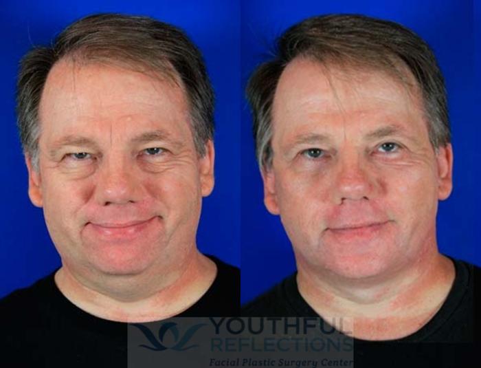 Facelift / Reflection Lift Case 71 Before & After Front | Nashville, TN | Youthful Reflections