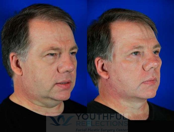 Upper Blepharoplasty Case 71 Before & After Right Oblique | Nashville, TN | Youthful Reflections