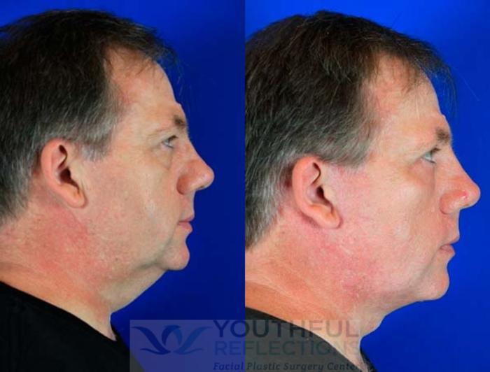 Facelift / Reflection Lift Case 71 Before & After Right Side | Nashville, TN | Youthful Reflections