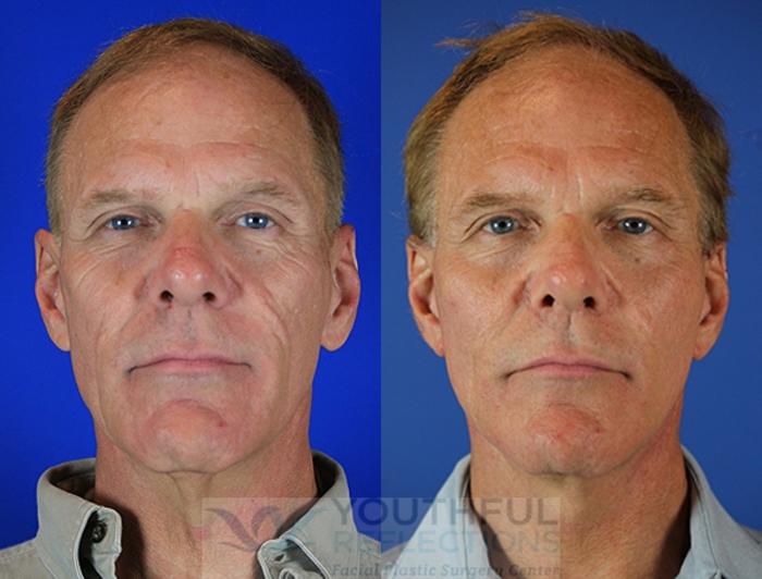 Facelift / Reflection Lift Case 72 Before & After Front | Nashville, TN | Youthful Reflections