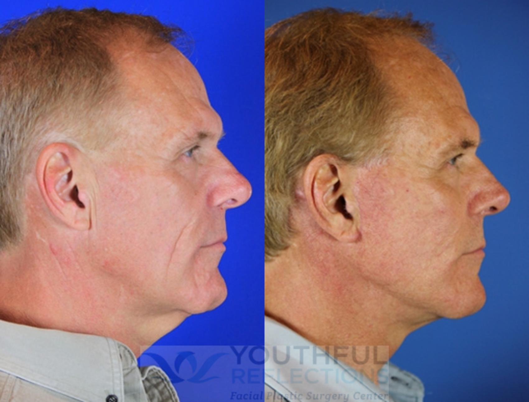 Cheek Implants Case 72 Before & After Right Side | Nashville, TN | Youthful Reflections