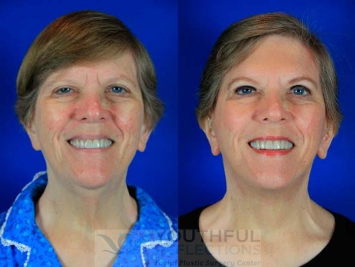 Facelift / Reflection Lift Case 73 Before & After Front | Nashville, TN | Youthful Reflections