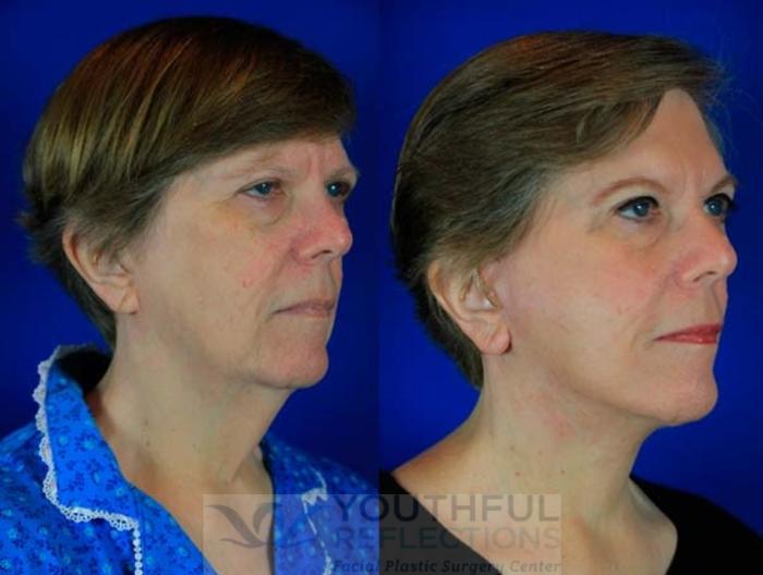 Facelift / Reflection Lift Case 73 Before & After Right Oblique | Nashville, TN | Youthful Reflections