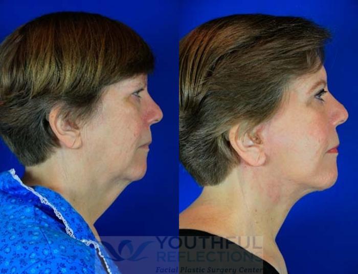 Facelift / Reflection Lift Case 73 Before & After Right Side | Nashville, TN | Youthful Reflections