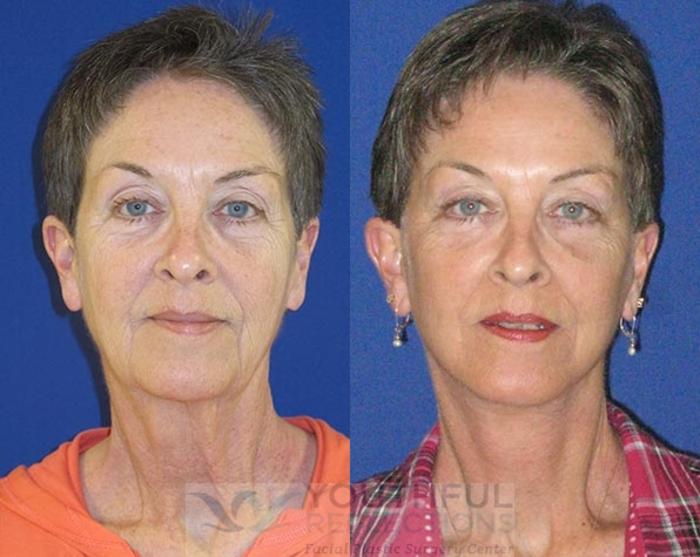 Facelift / Reflection Lift Case 74 Before & After Front | Nashville, TN | Youthful Reflections