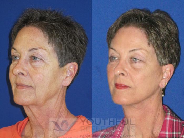 Brow Lift Case 74 Before & After Left Oblique | Nashville, TN | Youthful Reflections