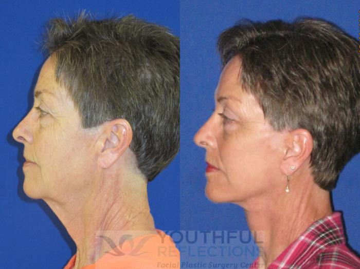 Facelift / Reflection Lift Case 74 Before & After Left Side | Nashville, TN | Youthful Reflections