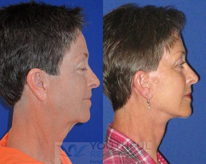 Facelift / Reflection Lift Case 74 Before & After Right Side | Nashville, TN | Youthful Reflections