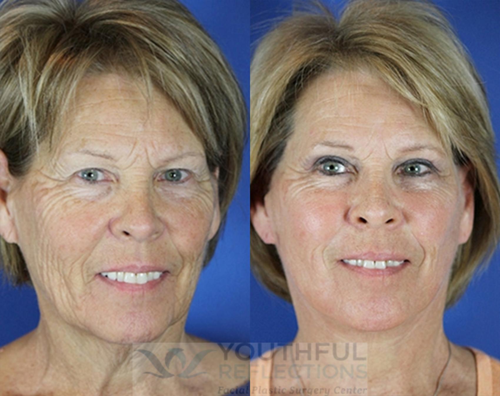 Facelift / Reflection Lift Case 75 Before & After Front | Nashville, TN | Youthful Reflections