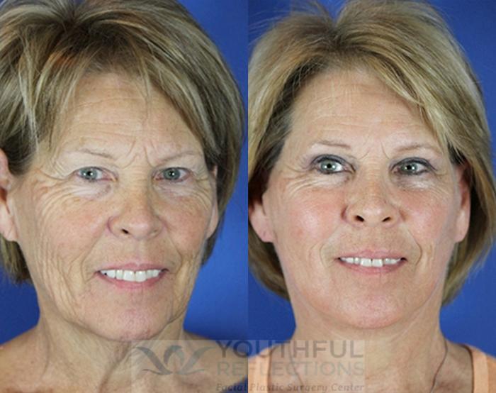 Facelift / Reflection Lift Case 75 Before & After Front | Nashville, TN | Youthful Reflections