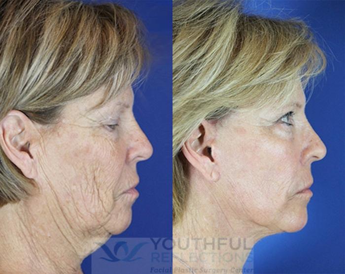 Facelift / Reflection Lift Case 75 Before & After Right Side | Nashville, TN | Youthful Reflections