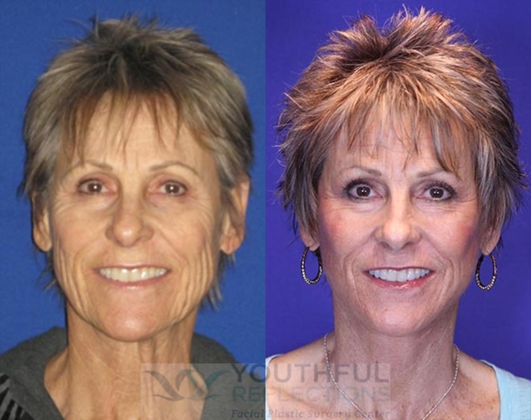 Co2 Laser Skin Resurfacing Before And After Photos Patient 76 Nashville Tn Youthful Reflections