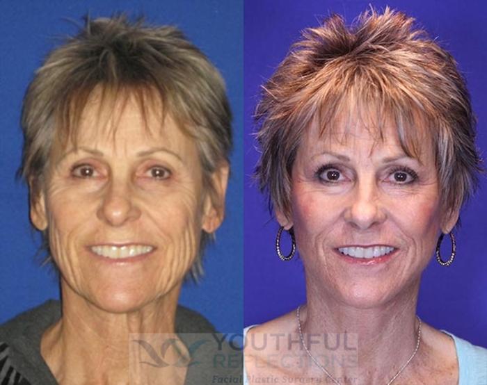 Facelift / Reflection Lift Case 76 Before & After Front | Nashville, TN | Youthful Reflections