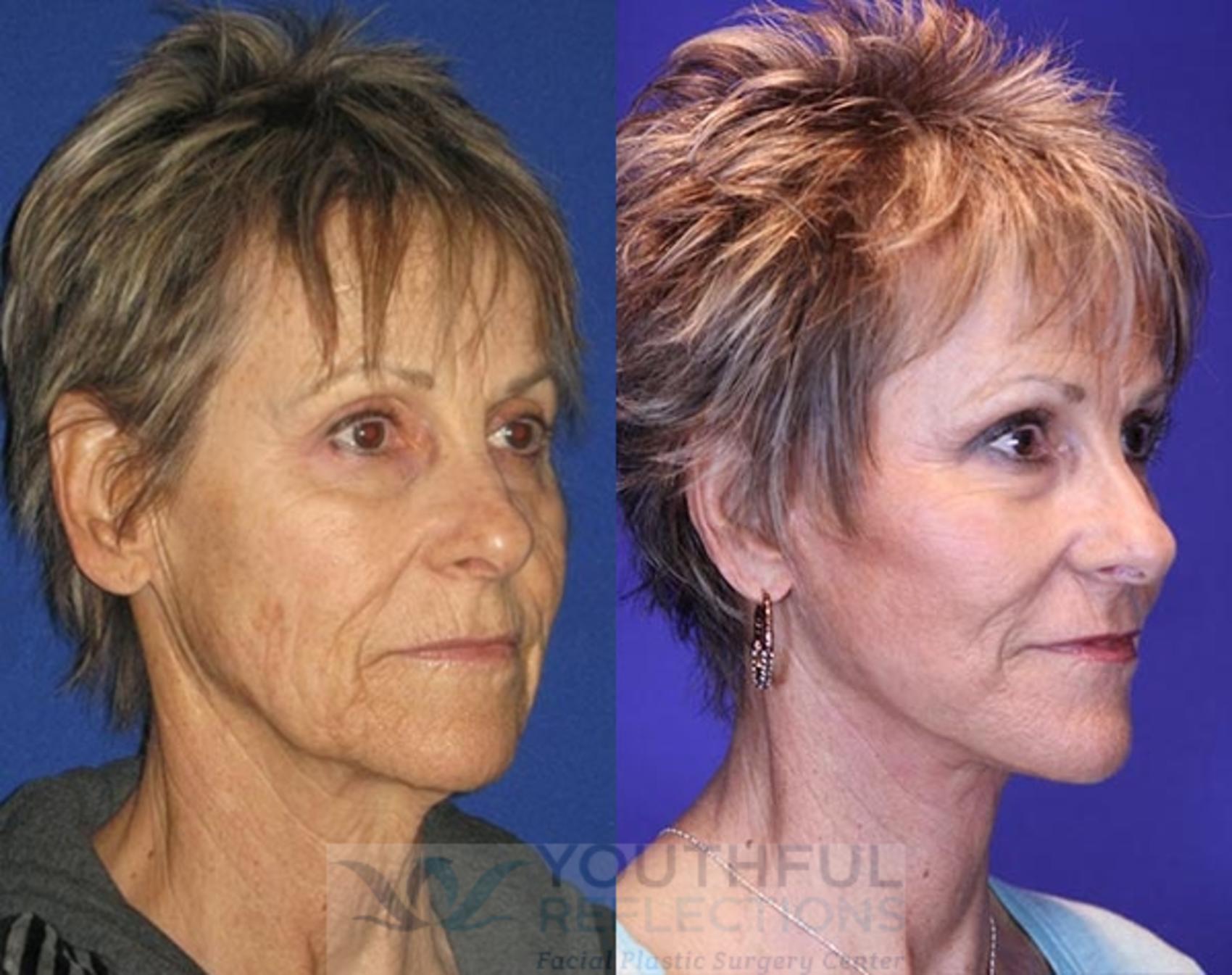 CO2 Laser Skin Resurfacing Case 76 Before & After Right Oblique | Nashville, TN | Youthful Reflections