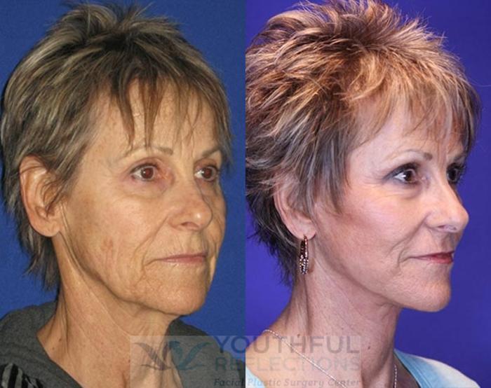 Facelift / Reflection Lift Case 76 Before & After Right Oblique | Nashville, TN | Youthful Reflections