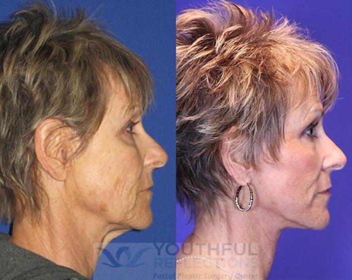 Facelift / Reflection Lift Case 76 Before & After Right Side | Nashville, TN | Youthful Reflections