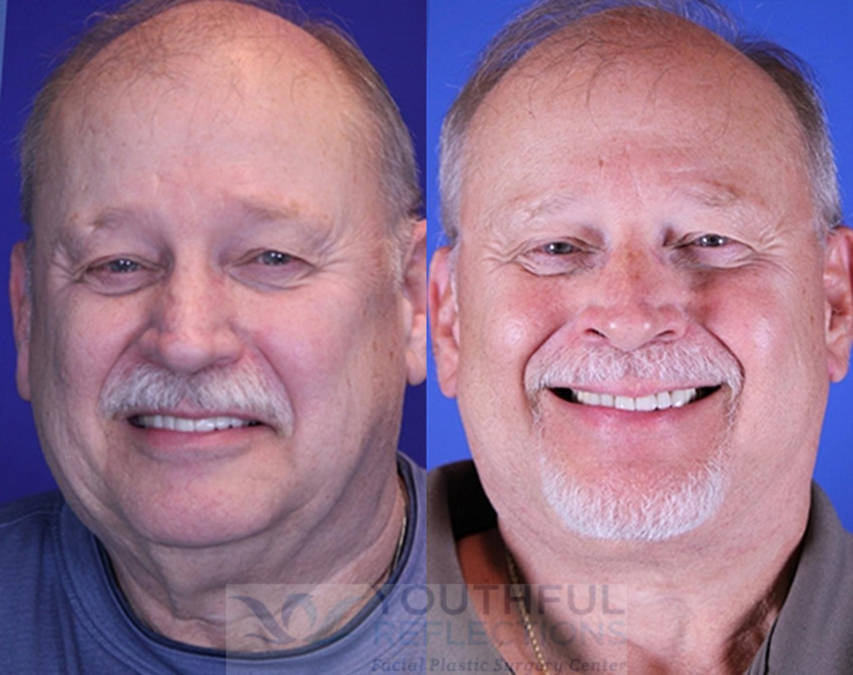 Facelift / Reflection Lift Case 77 Before & After Front | Nashville, TN | Youthful Reflections