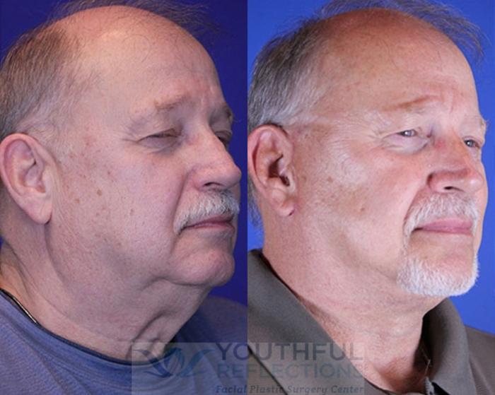 Facelift / Reflection Lift Case 77 Before & After Right Oblique | Nashville, TN | Youthful Reflections