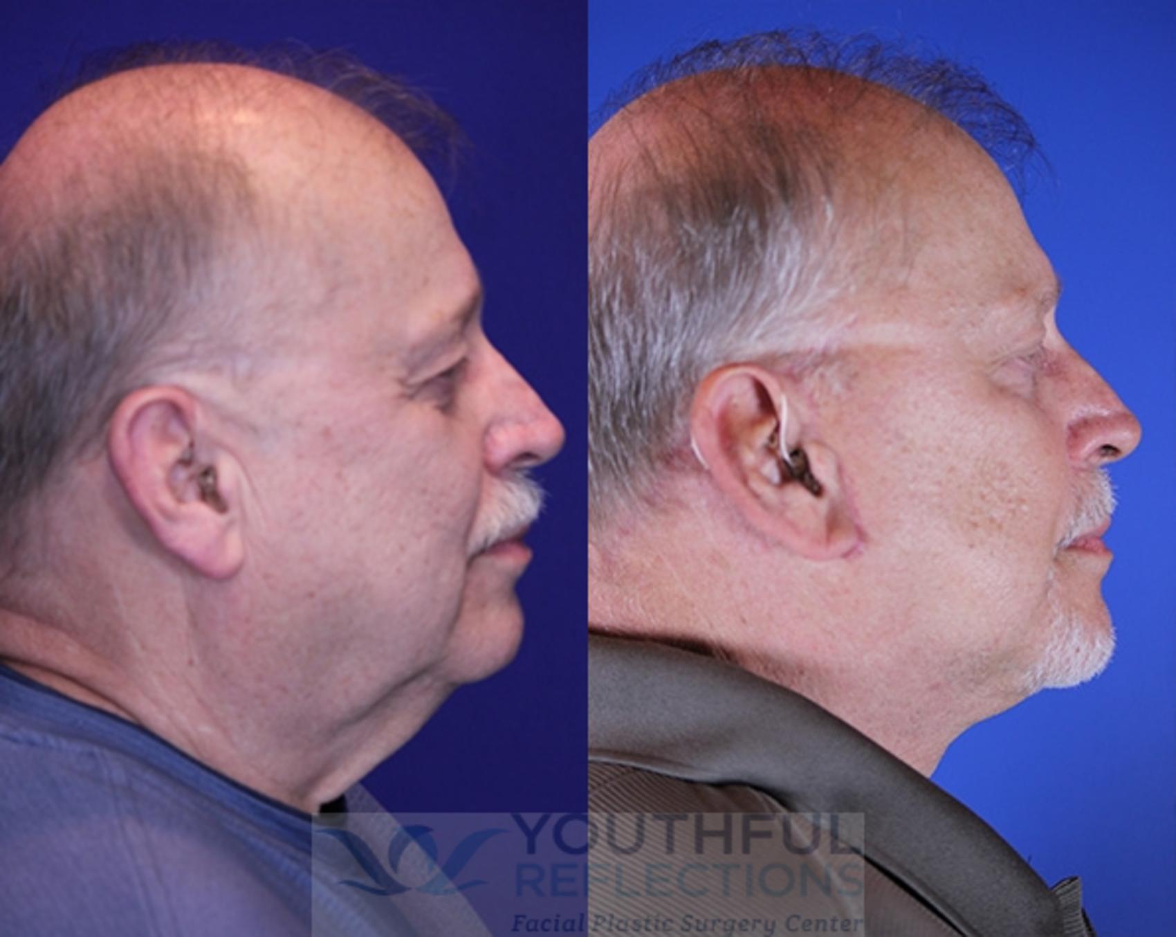 Facelift / Reflection Lift Case 77 Before & After Right Side | Nashville, TN | Youthful Reflections
