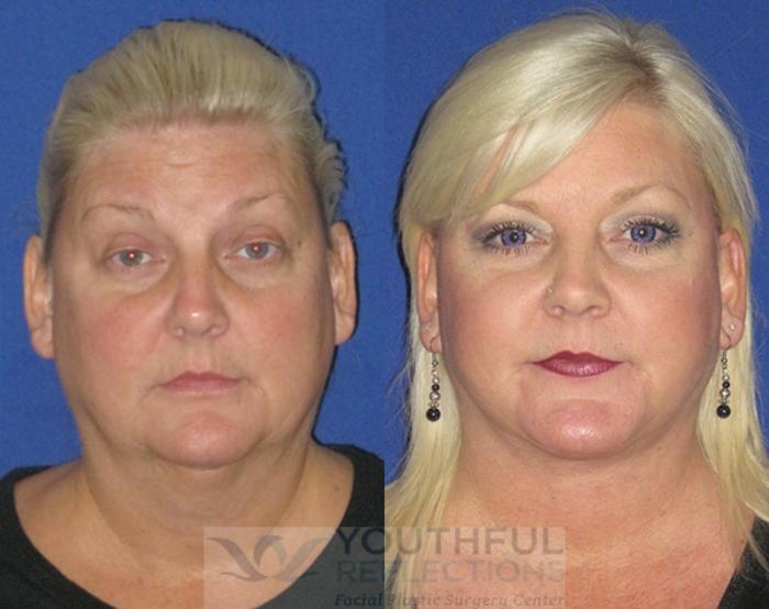 Facelift / Reflection Lift Case 78 Before & After Front | Nashville, TN | Youthful Reflections