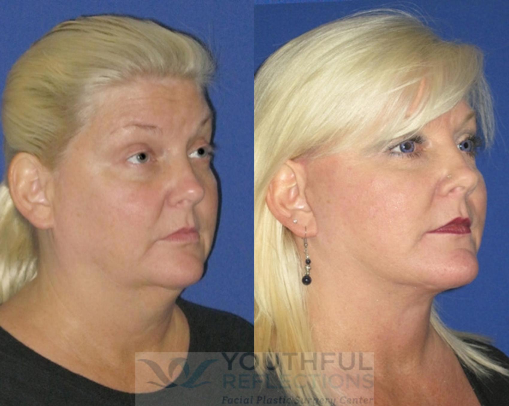 Facelift / Reflection Lift Case 78 Before & After Right Oblique | Nashville, TN | Youthful Reflections