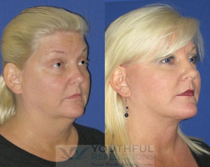 Facelift / Reflection Lift Case 78 Before & After Right Oblique | Nashville, TN | Youthful Reflections