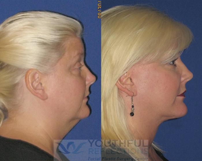 Facelift / Reflection Lift Case 78 Before & After Right Side | Nashville, TN | Youthful Reflections