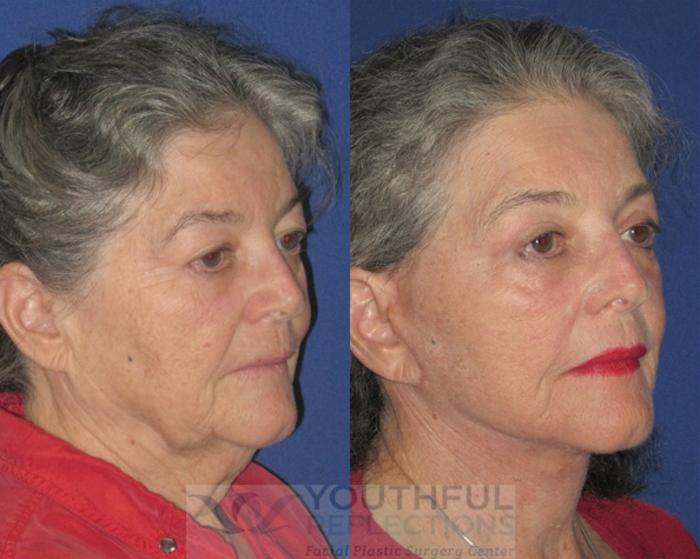 Facelift / Reflection Lift Case 79 Before & After Right Oblique | Nashville, TN | Youthful Reflections