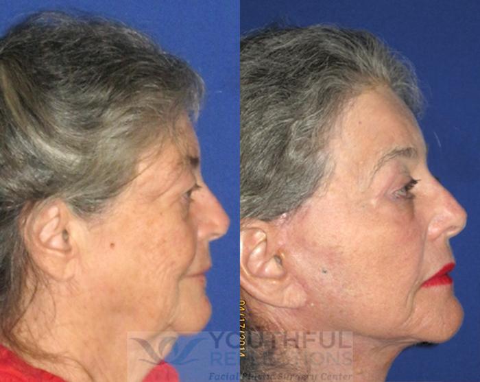 Facelift / Reflection Lift Case 79 Before & After Right Side | Nashville, TN | Youthful Reflections