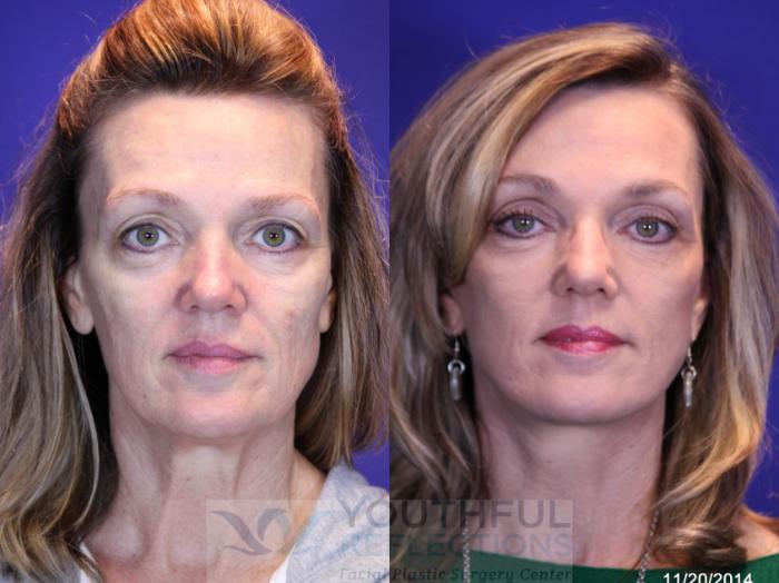 Facelift / Reflection Lift Case 8 Before & After Front | Nashville, TN | Youthful Reflections