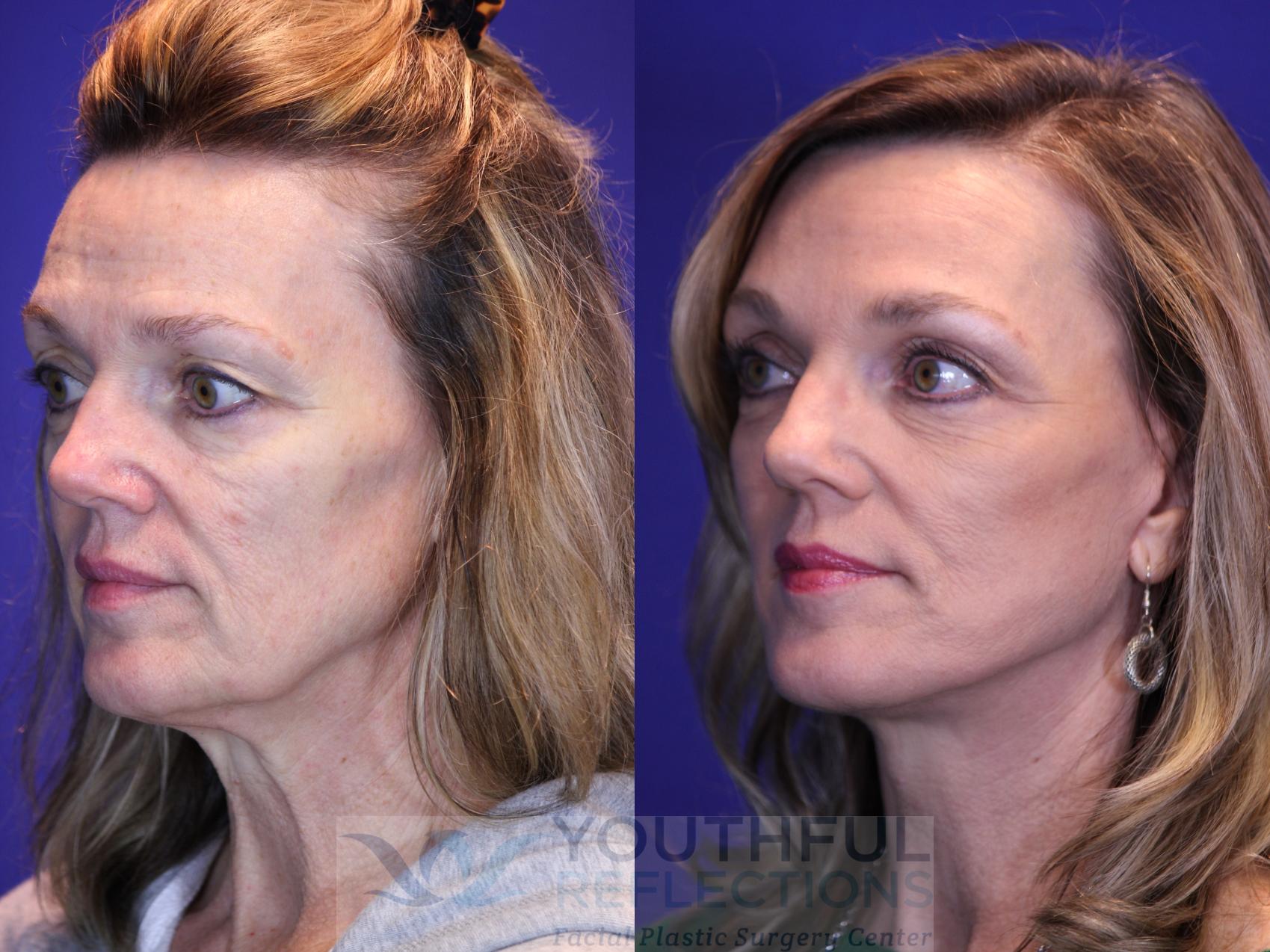 CO2 Laser Skin Resurfacing Before & After Photos Patient 8 | Nashville ...