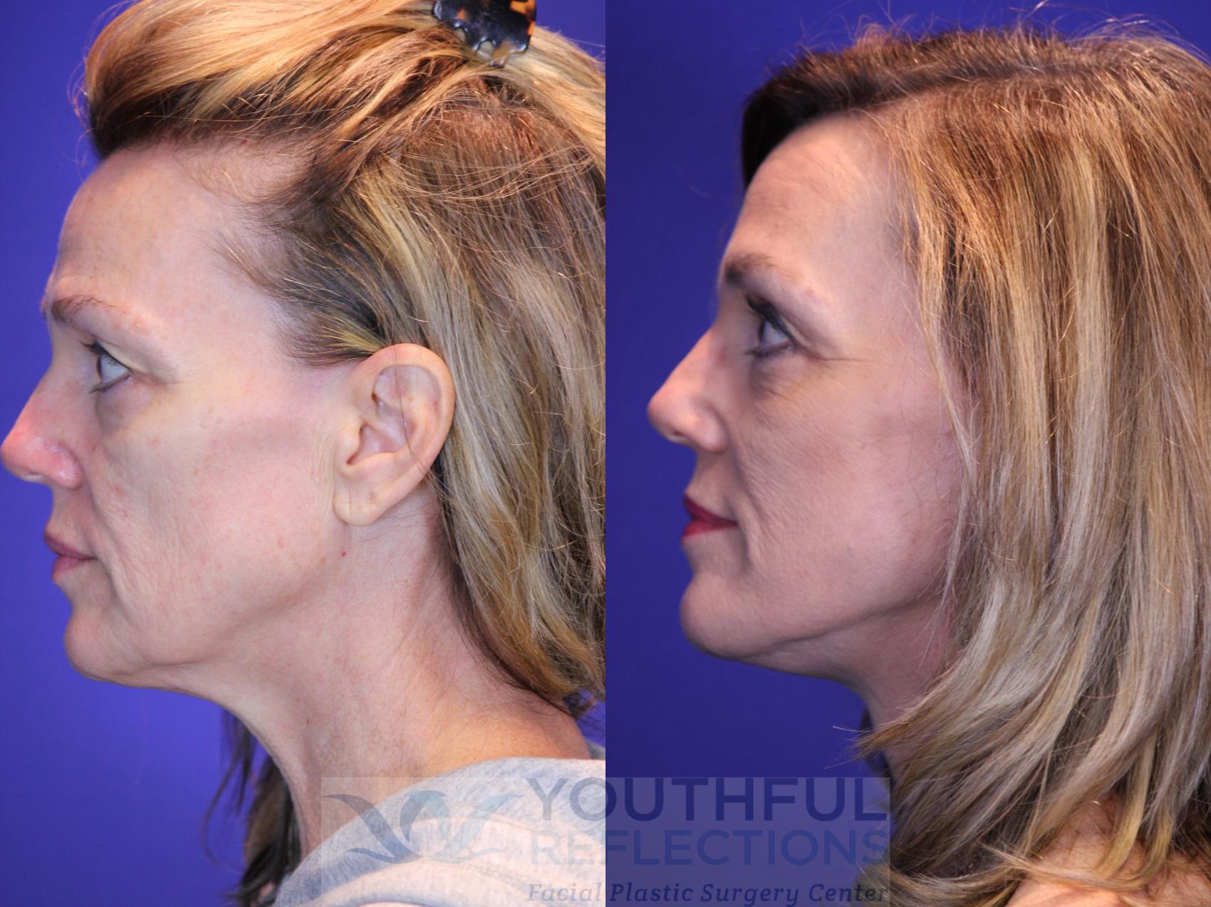 Facelift / Reflection Lift Case 8 Before & After Left Side | Nashville, TN | Youthful Reflections