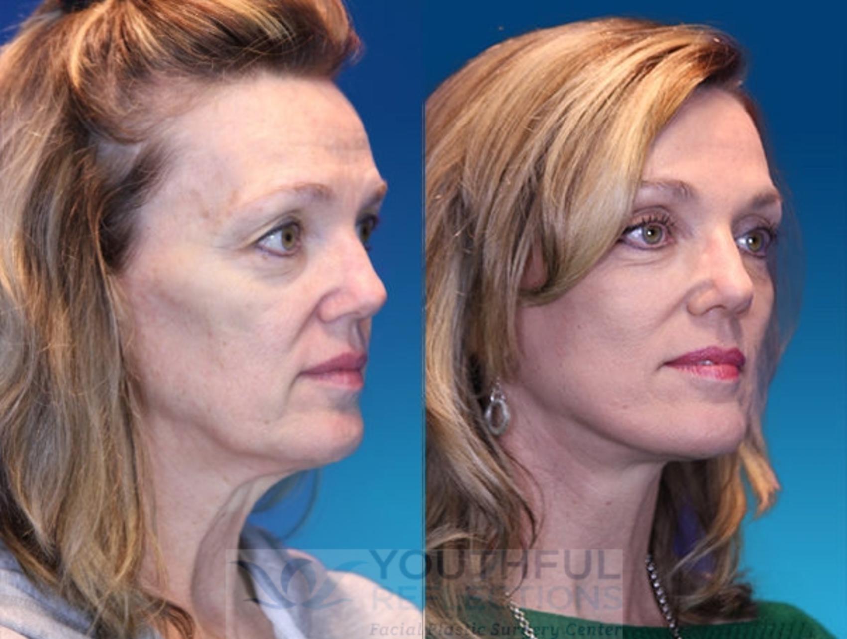 Facelift / Reflection Lift Case 8 Before & After Right Oblique | Nashville, TN | Youthful Reflections