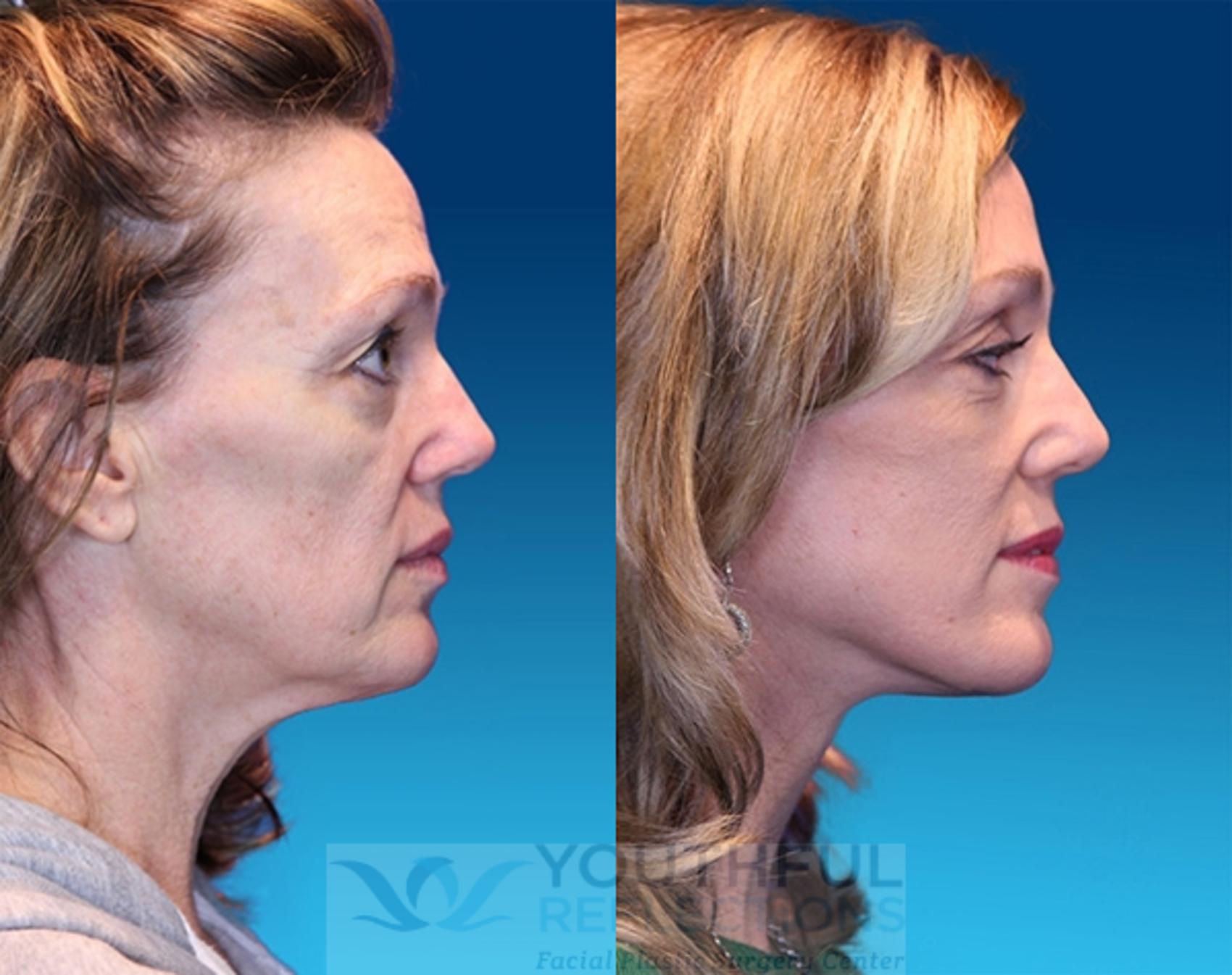 Facelift / Reflection Lift Case 8 Before & After Right Side | Nashville, TN | Youthful Reflections