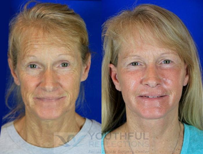 Facelift / Reflection Lift Case 82 Before & After Front | Nashville, TN | Youthful Reflections