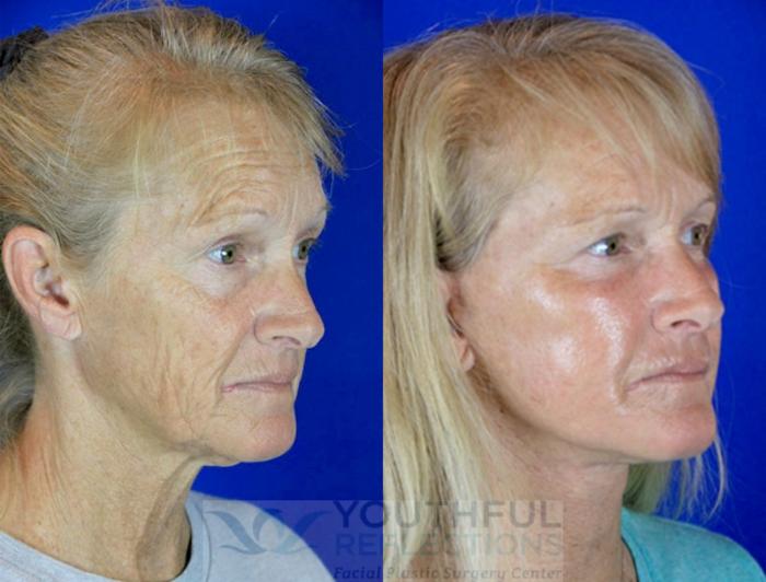 Facelift / Reflection Lift Case 82 Before & After Right Oblique | Nashville, TN | Youthful Reflections
