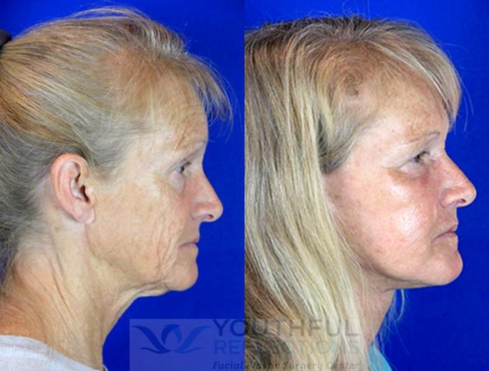 Facelift / Reflection Lift Case 82 Before & After Right Side | Nashville, TN | Youthful Reflections