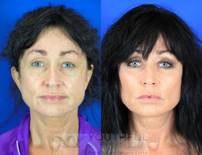 Facelift / Reflection Lift Case 83 Before & After Front | Nashville, TN | Youthful Reflections