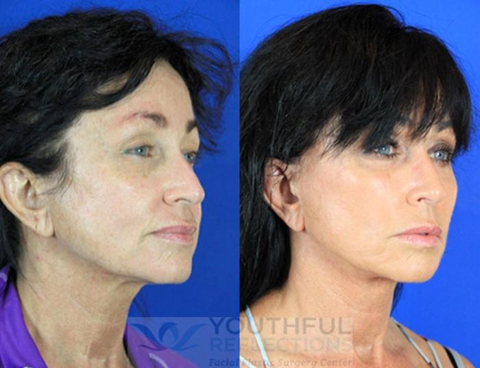 Facelift / Reflection Lift Case 83 Before & After Right Oblique | Nashville, TN | Youthful Reflections