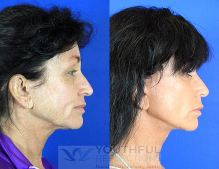 Facelift / Reflection Lift Case 83 Before & After Right Side | Nashville, TN | Youthful Reflections