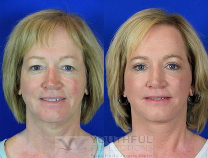 CO2 Laser Skin Resurfacing Case 84 Before & After Front | Nashville, TN | Youthful Reflections
