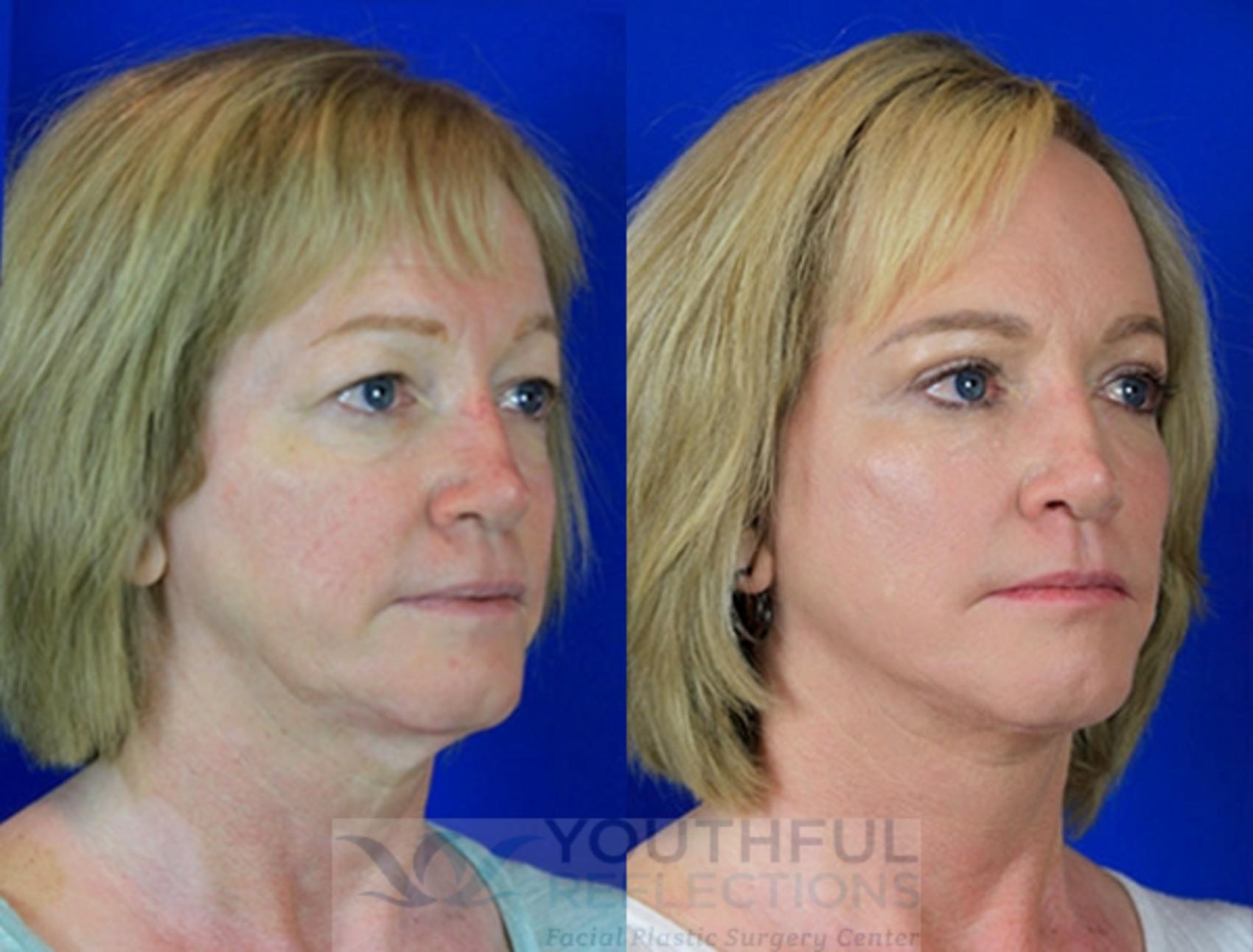 CO2 Laser Skin Resurfacing Case 84 Before & After Right Oblique | Nashville, TN | Youthful Reflections