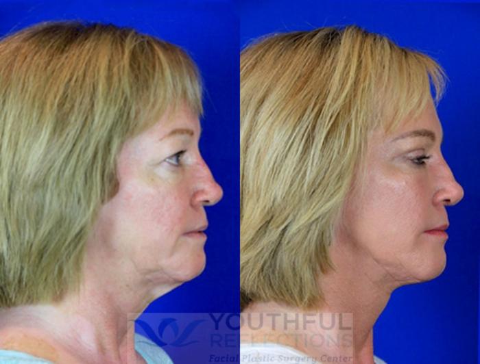 Facelift / Reflection Lift Case 84 Before & After Right Side | Nashville, TN | Youthful Reflections
