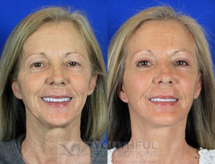 Brow Lift Case 85 Before & After Front | Nashville, TN | Youthful Reflections