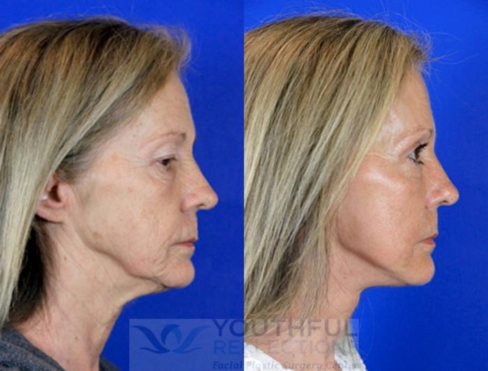 Facelift / Reflection Lift Case 85 Before & After Right Side | Nashville, TN | Youthful Reflections
