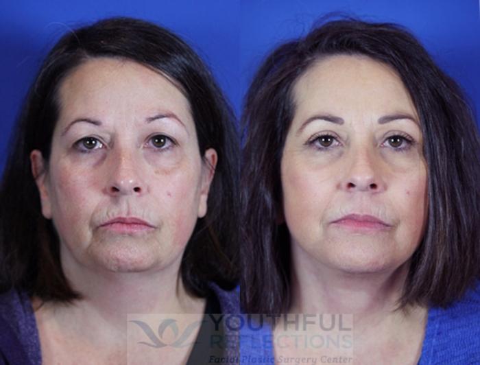 Facelift / Reflection Lift Case 86 Before & After Front | Nashville, TN | Youthful Reflections