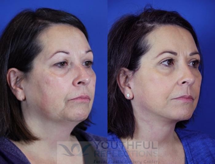 Facelift / Reflection Lift Case 86 Before & After Right Oblique | Nashville, TN | Youthful Reflections