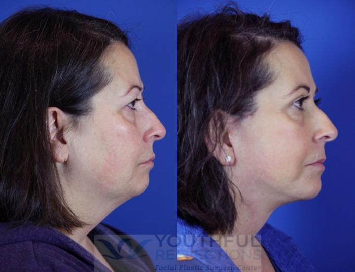Facelift / Reflection Lift Case 86 Before & After Right Side | Nashville, TN | Youthful Reflections