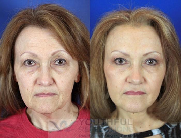 Facelift / Reflection Lift Case 87 Before & After Front | Nashville, TN | Youthful Reflections